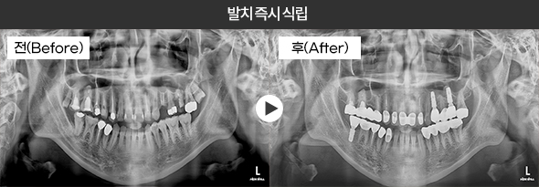 발치 즉시 식립 임플란트 전후 엑스레이 1