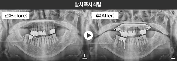 발치 즉시 식립 임플란트 전후 엑스레이 2