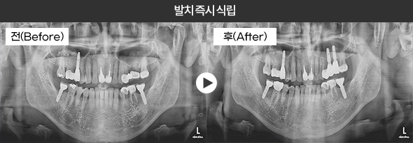 발치 즉시 식립 임플란트 전후 엑스레이 3