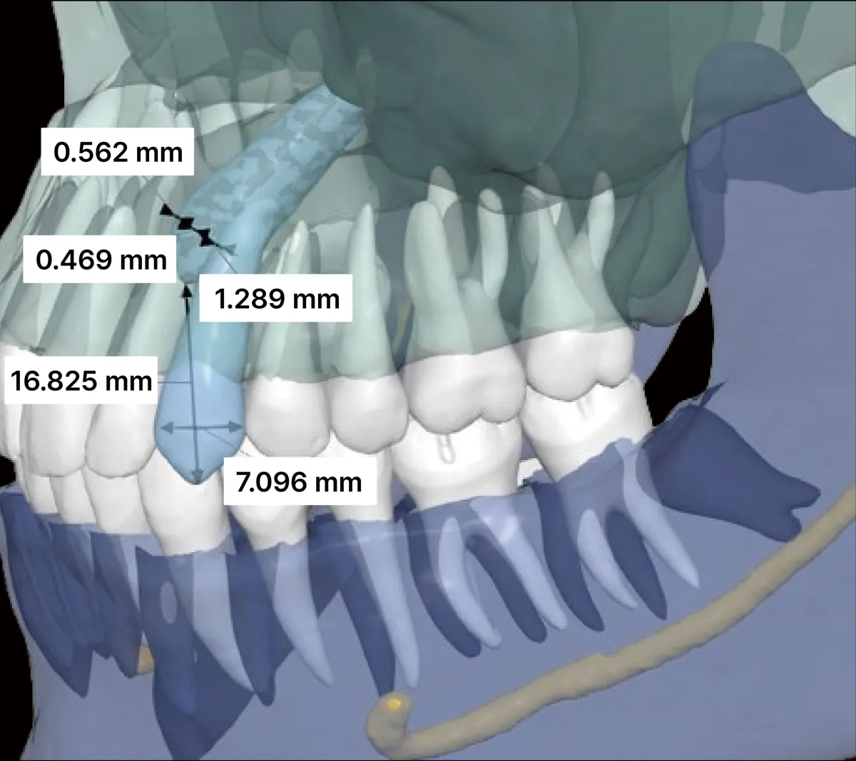 CT 3D 영상에서 위턱 뼈 속에 있는 치아의 길이·폭과 주변 구조까지의 거리를 mm 단위로 측정한 화면