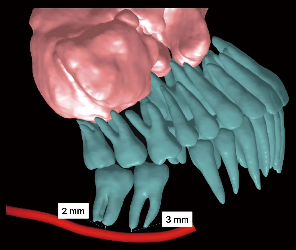 CT 3D 영상에서 아래턱 어금니 뿌리 끝과 신경(붉은 선) 사이 거리를 2mm, 3mm로 표시한 화면