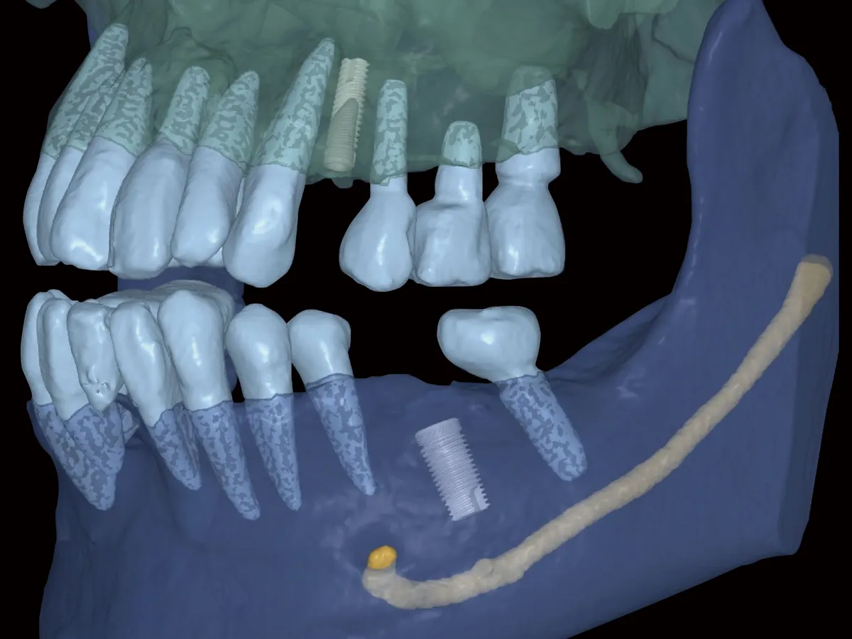 CT 3D 영상: 아래턱뼈 속 임플란트와 노란색 신경관의 위치를 함께 보여주는 화면